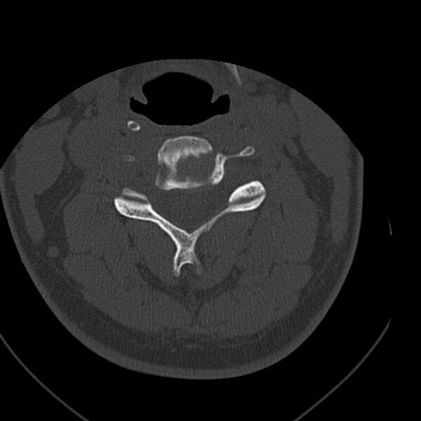 File:Occipital condyle fracture (Radiopaedia 31755-32691 Axial bone window 35).jpg