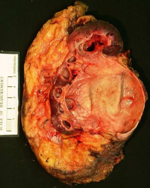 File:Pelvi-ureteric junction obstruction with hydronephrosis (gross pathology) (Radiopaedia 29670).JPG