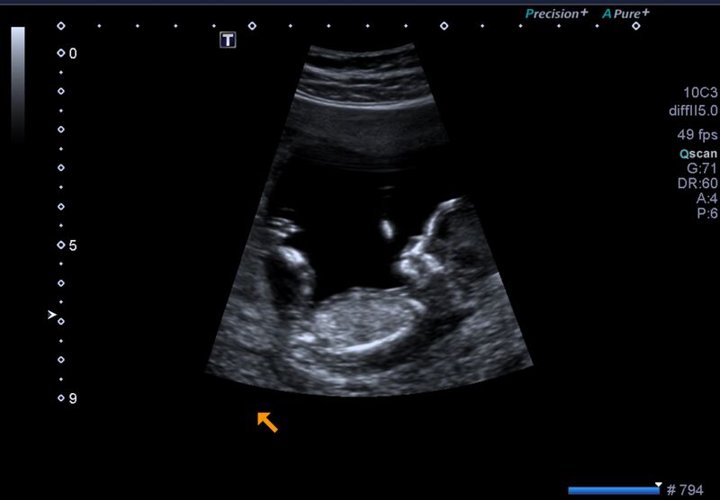 File:1st trimester nuchal-morphology ultrasound (Radiopaedia 44706-48477 General anatomy and NT 6).jpg