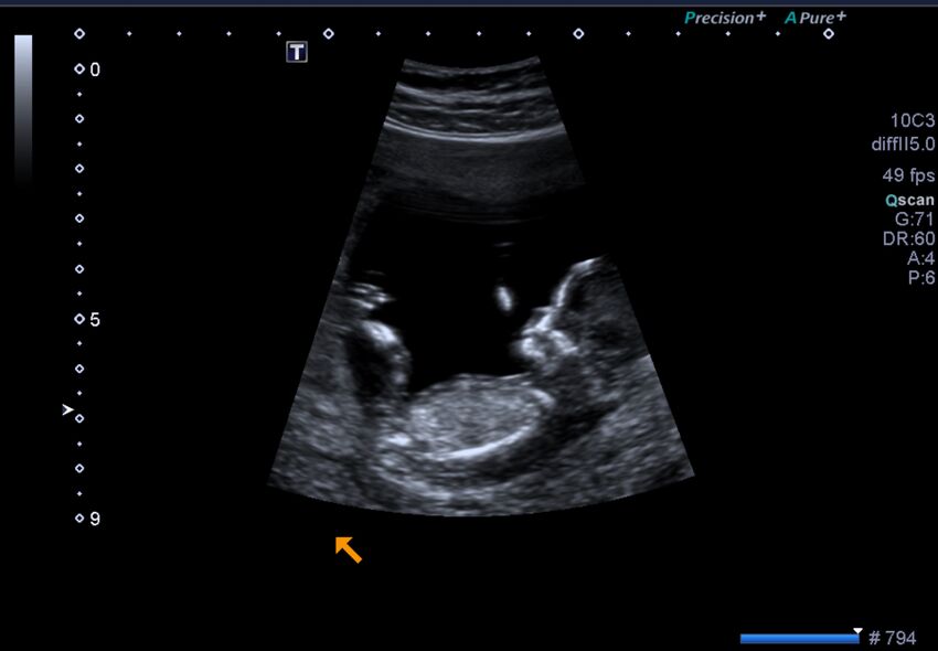 1st trimester nuchal-morphology ultrasound (Radiopaedia 44706-48477 General anatomy and NT 6).jpg