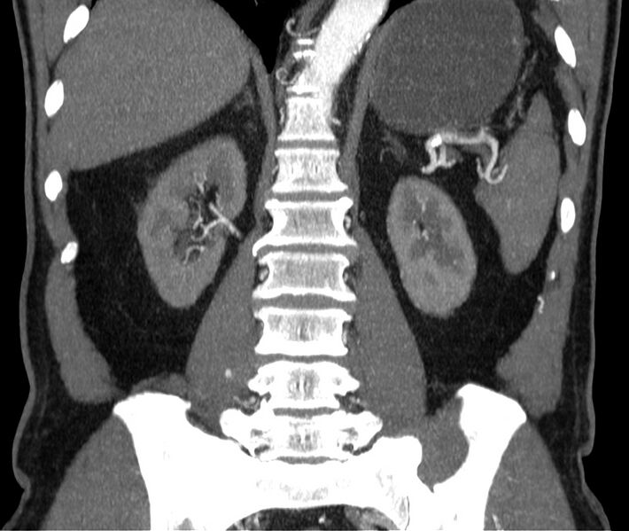 File:Abdominal aortic aneurysm (Radiopaedia 22421-22458 C 31).jpg