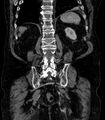 Abdominal aortic aneurysm (Radiopaedia 25855-26001 Coronal C+ arterial phase 61).jpg