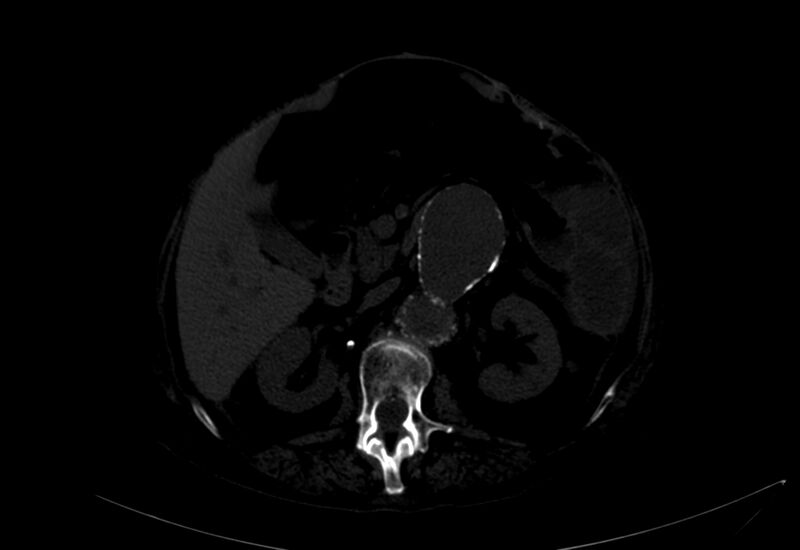 File:Abdominal aortic aneurysm - impending rupture (Radiopaedia 19233-19246 B 2).jpg