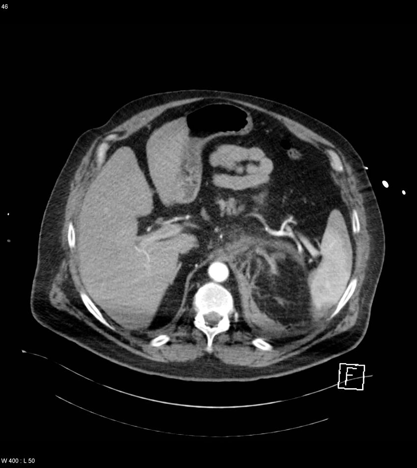 Abdominal aortic aneurysm with intramural hematoma then rupture (Radiopaedia 50278-55632 Axial C+ arterial phase 45).jpg