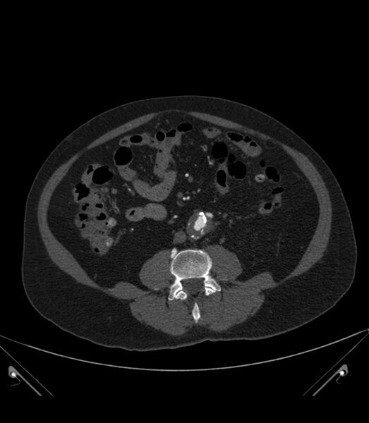File:Abdominal aortic aneurysm with thrombus fissuration (Radiopaedia 46218-50618 Axial C+ arterial phase 23).jpg
