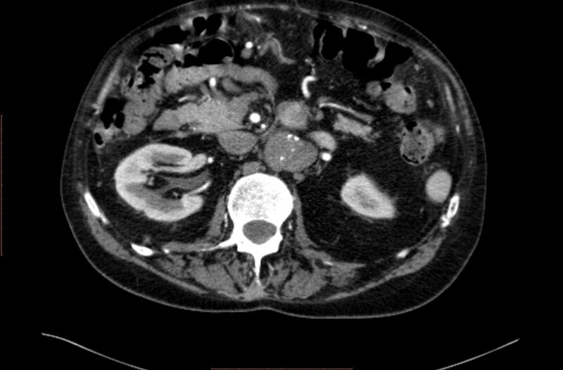 File:Abdominal aortic interposition tube graft and aneurysm thrombosis (Radiopaedia 71438-81857 Axial C+ arterial phase 47).jpg