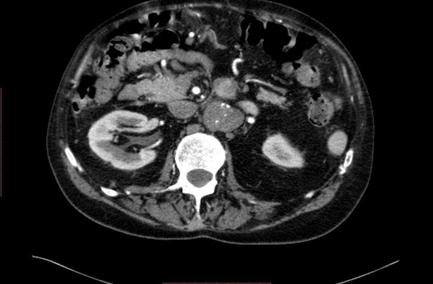 Abdominal aortic interposition tube graft and aneurysm thrombosis (Radiopaedia 71438-81857 Axial C+ arterial phase 47).jpg