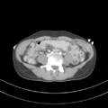 Abdominal multi-trauma - devascularised kidney and liver, spleen and pancreatic lacerations (Radiopaedia 34984-36486 Axial C+ portal venous phase 52).png
