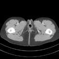 Abdominal multi-trauma - devascularised kidney and liver, spleen and pancreatic lacerations (Radiopaedia 34984-36486 Axial C+ portal venous phase 92).png