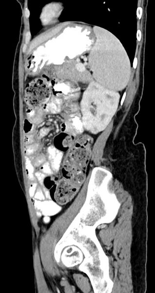 File:Abdominal wall and retroperitoneal tuberculosis (Radiopaedia 88137-104729 Sagittal C+ portal venous phase 44).jpg
