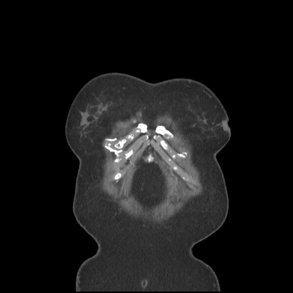 File:Aberrant right subclavian and left vertebral arteries (Radiopaedia 43467-46847 Coronal C+ portal venous phase 4).jpg