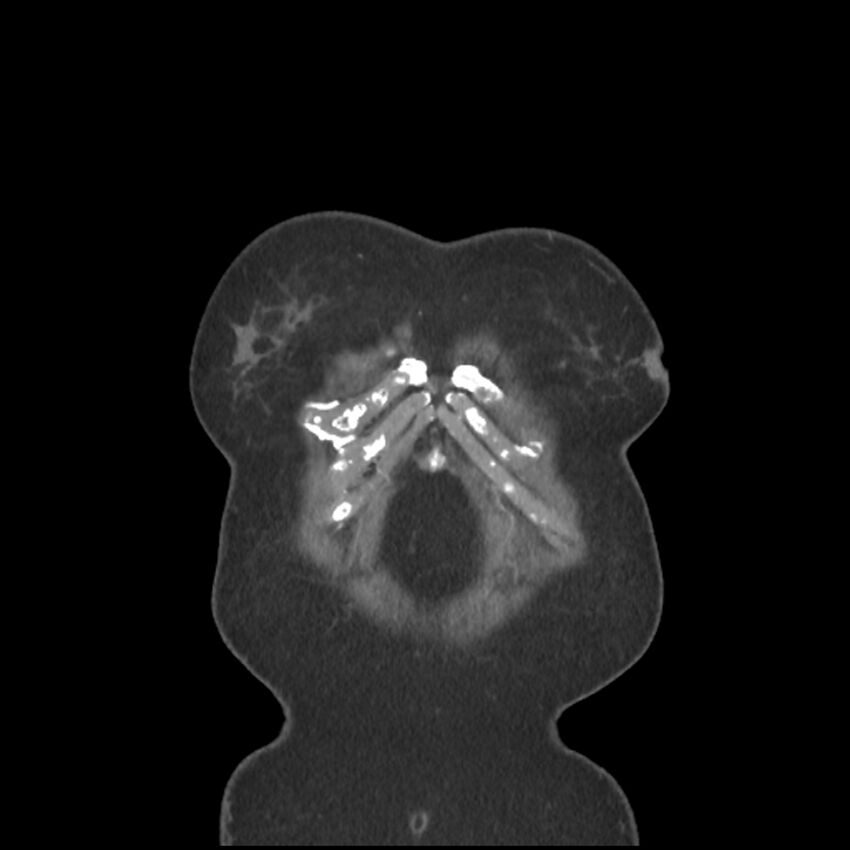 Aberrant right subclavian and left vertebral arteries (Radiopaedia 43467-46847 Coronal C+ portal venous phase 4).jpg