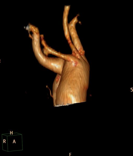 File:Aberrant right subclavian artery (Radiopaedia 67135-76475 volume rendering C+ arterial phase 3).jpg