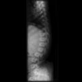 Achondroplasia (Radiopaedia 5867-7443 C 1).jpg