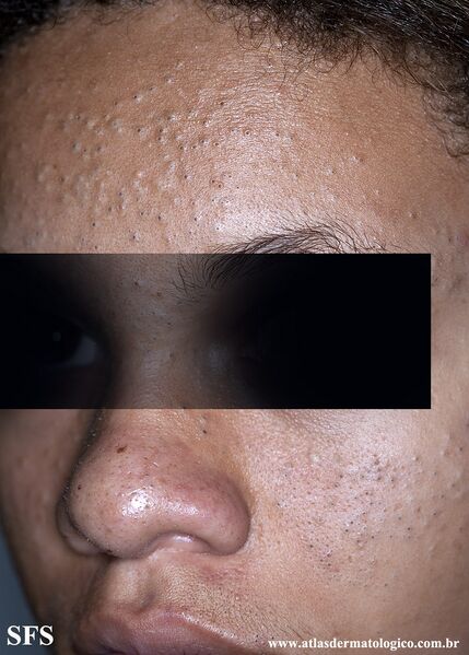 File:Acne (Dermatology Atlas 25).jpg