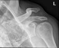 Acromioclavicular joint injury (type V) (Radiopaedia 44768-48582 B 1).png