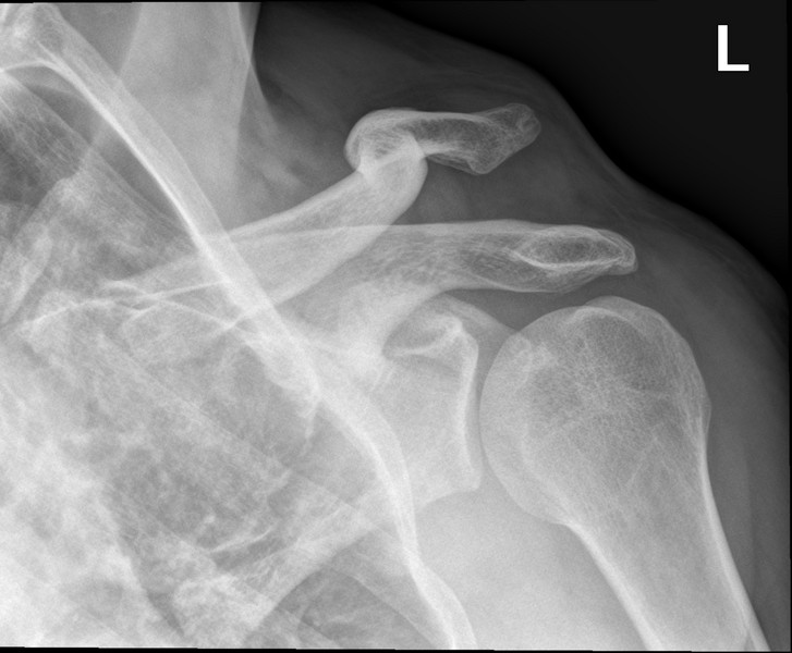 File:Acromioclavicular joint injury (type V) (Radiopaedia 44768-48582 B 1).png