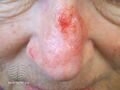 Actinic Keratoses treated with imiquimod (DermNet NZ lesions-ak-imiquimod-3725).jpg