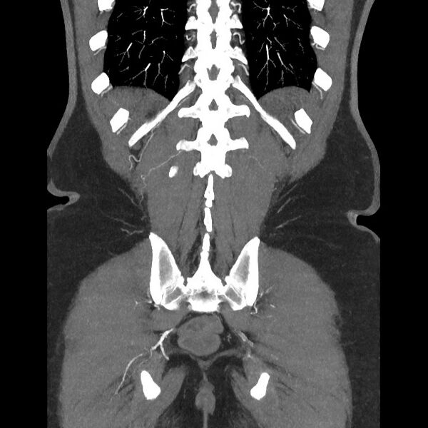 File:Active colonic bleed on CT (Radiopaedia 49765-55025 Coronal art MIP 51).jpg