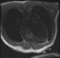 Active right ventricular cardiac sarcoidosis (Radiopaedia 55596-62100 Axial Dynamic perfusion scan MOCO 23).jpg