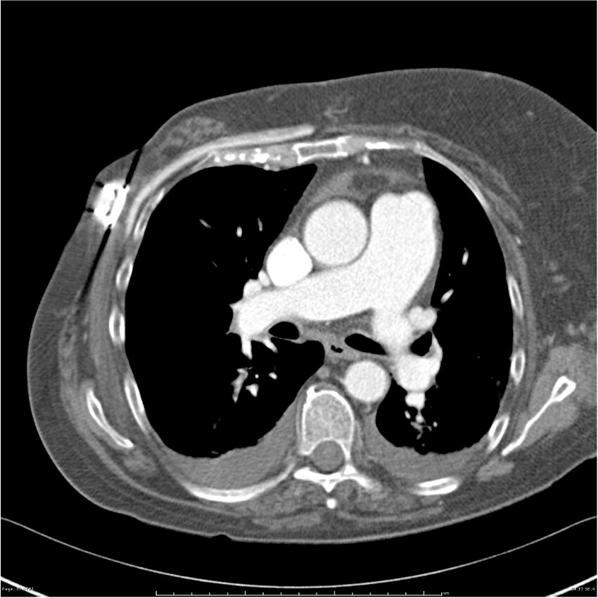 Acute-on-chronic pulmonary emboli (Radiopaedia 27925-28169 C+ CTPA 37).jpg