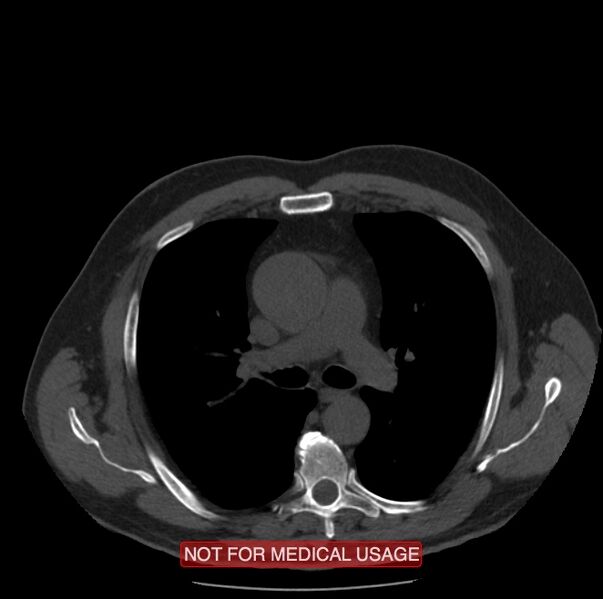 File:Acute aortic dissection - Stanford type A (Radiopaedia 40661-43285 Axial non-contrast 19).jpg