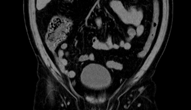 File:Acute appendicitis (Radiopaedia 13030-13091 Coronal non-contrast 4).jpg