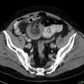 Acute appendicitis arising from a malrotated cecum (Radiopaedia 19970-19997 Axial C+ portal venous phase 38).jpg