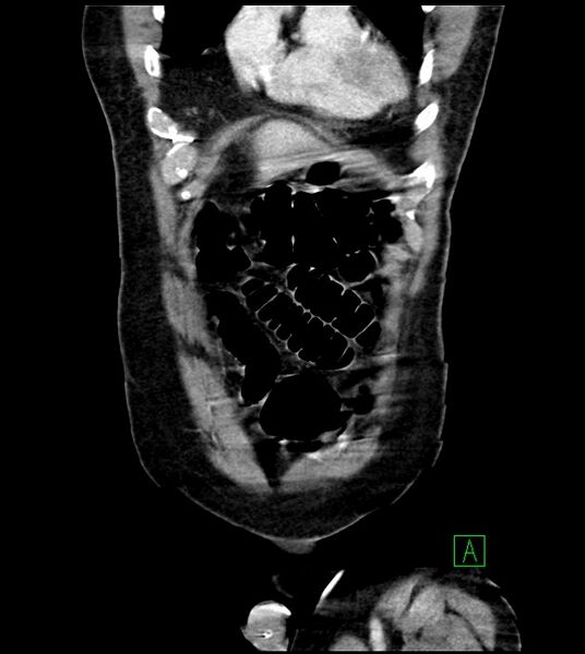 File:Acute arterial mesenteric ischemia (Radiopaedia 78238-90828 Coronal C+ portal venous phase 22).jpg