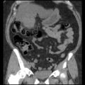 Acute cholecystitis and ureteric colic (Radiopaedia 42330-45444 Coronal prone 39).jpg