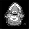 Acute left parotid sialadenitis (Radiopaedia 26160-26295 C+ arterial phase 29).jpg