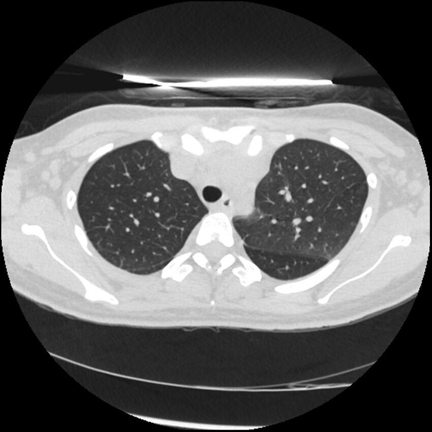 Acute lupus nephritis (Radiopaedia 45832-50107 Axial lung window 20).jpg