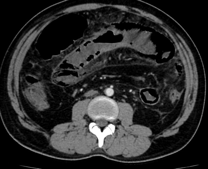 Acute mesenteric ischemia - superior mesenteric artery thrombosis (Radiopaedia 73947-84776 Axial C+ arterial phase 65).jpg