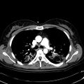 Acute myocardial infarction in CT (Radiopaedia 39947-42415 Axial C+ arterial phase 51).jpg