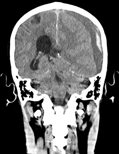 File:Acute on chronic subdural hematoma (Radiopaedia 74814-85823 Coronal non-contrast 42).jpg
