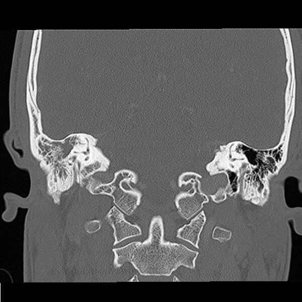 File:Acute otomastoiditis (Radiopaedia 28329-28575 Coronal bone window 8).jpg