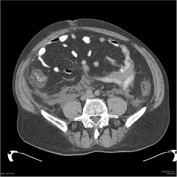 File:Acute pancreatitis (Radiopaedia 19135-19116 Axial non-contrast 39).jpg