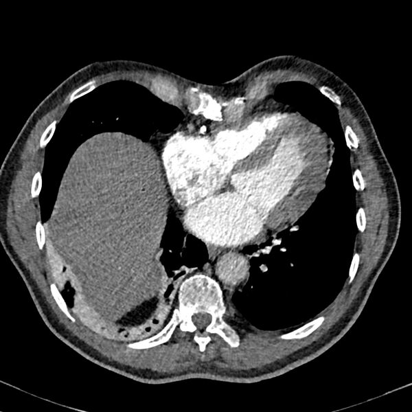 File:Acute pulmonary embolism (Radiopaedia 81677-95570 Axial C+ CTPA 80).jpg