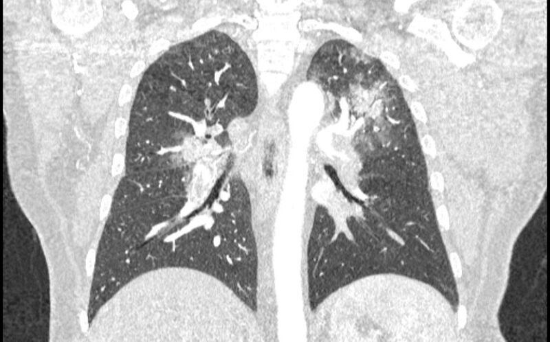 File:Acute pulmonary embolism with pulmonary infarcts (Radiopaedia 77688-89908 Coronal lung window 61).jpg