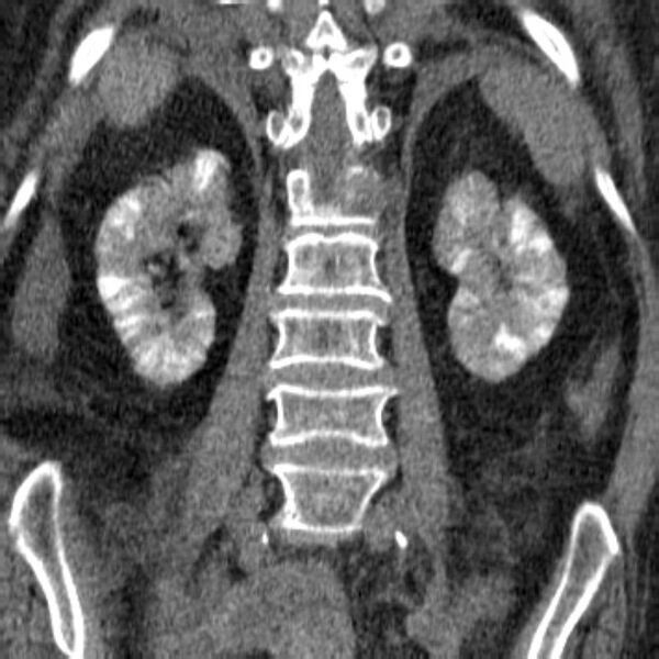 File:Acute tubular necrosis (Radiopaedia 28077-28334 C 22).jpg