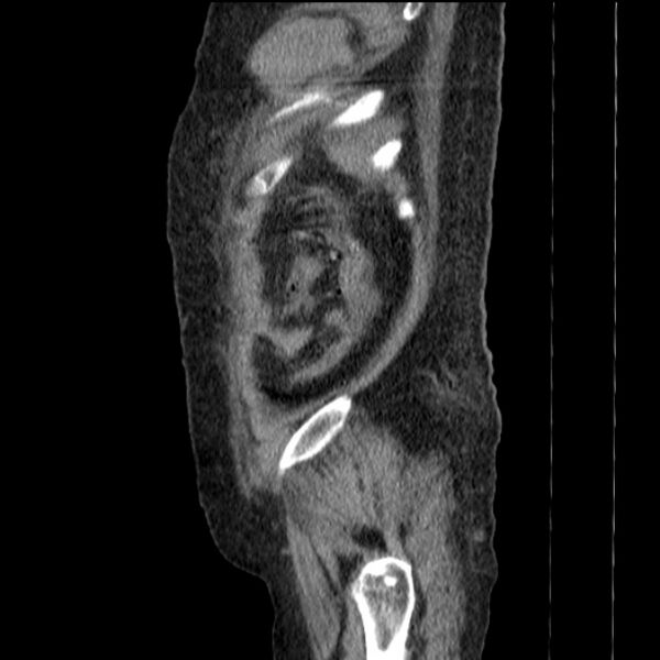 File:Acute tubular necrosis (Radiopaedia 28077-28334 H 77).jpg