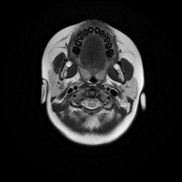 File:Adamantinomatous craniopharyngioma (Radiopaedia 77407-89529 Axial T2 1).jpg