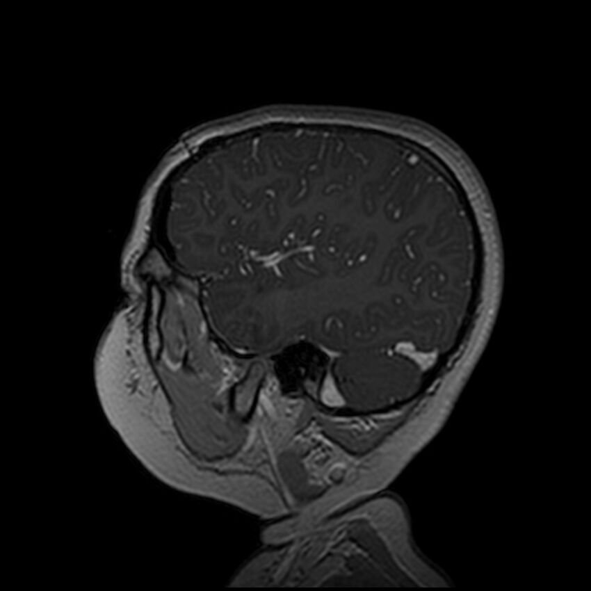 Adamantinomatous craniopharyngioma (Radiopaedia 77407-89529 H 26).jpg