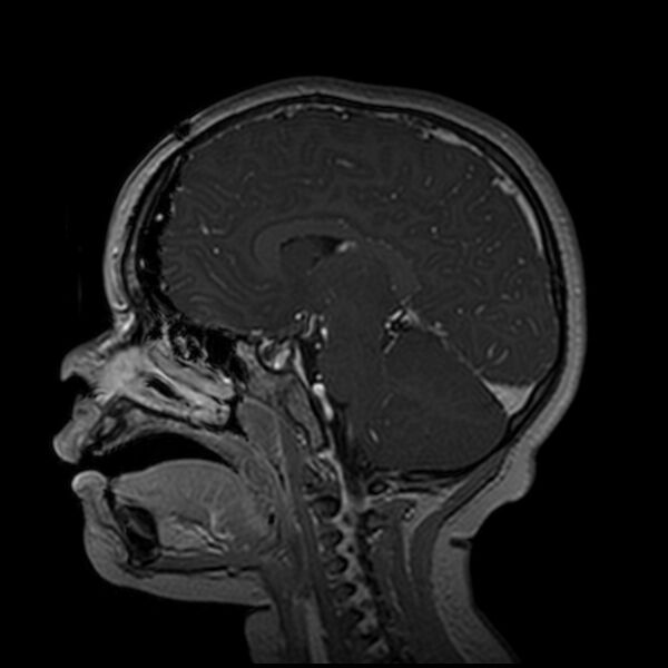 File:Adamantinomatous craniopharyngioma (Radiopaedia 77407-89529 H 55).jpg