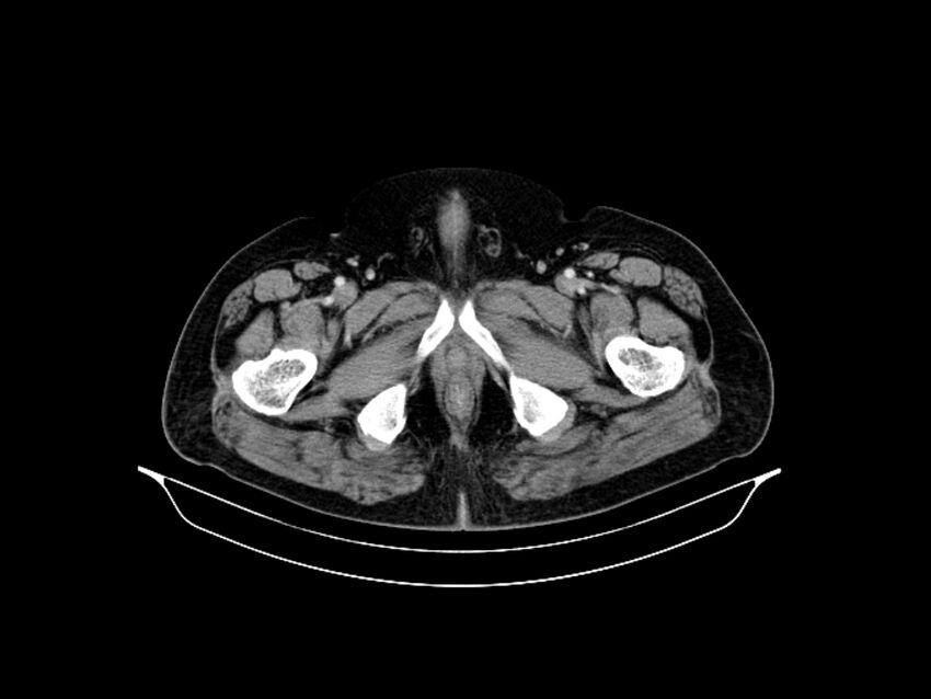 Adenocarcinoma of pancreas with hepatic metastasis (Radiopaedia 64332-73122 Axial C+ portal venous phase 104).jpg