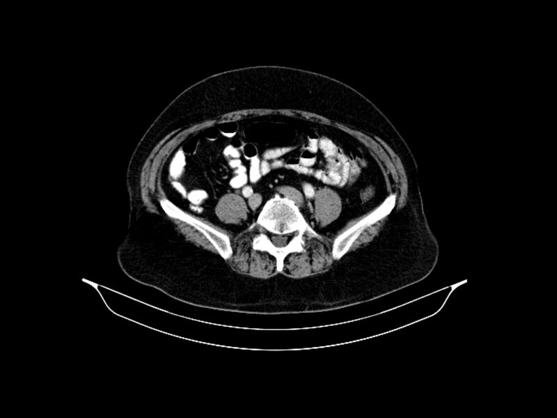 File:Adenocarcinoma of pancreas with hepatic metastasis (Radiopaedia 64332-73122 Axial C+ portal venous phase 71).jpg