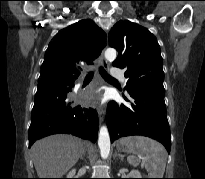 File:Adenocarcinoma of the lung (Radiopaedia 44205-47803 Coronal C+ portal venous phase 53).jpg