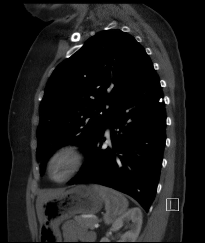 Adenocarcinoma of the lung (Radiopaedia 44205-47803 Sagittal C+ portal venous phase 18).jpg
