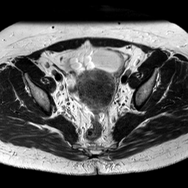 File:Adenomyoma of the uterus (Radiopaedia 9871-10439 Axial T2 18).jpg