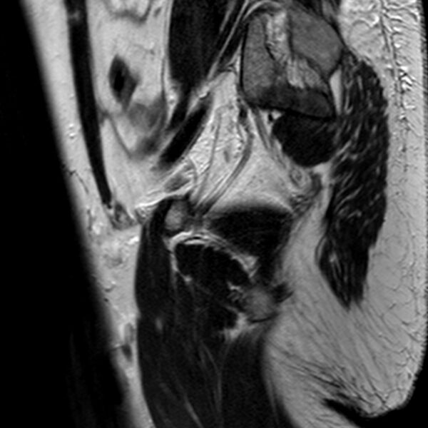 File:Adenomyoma of the uterus (Radiopaedia 9871-10439 Sagittal T2 4).jpg